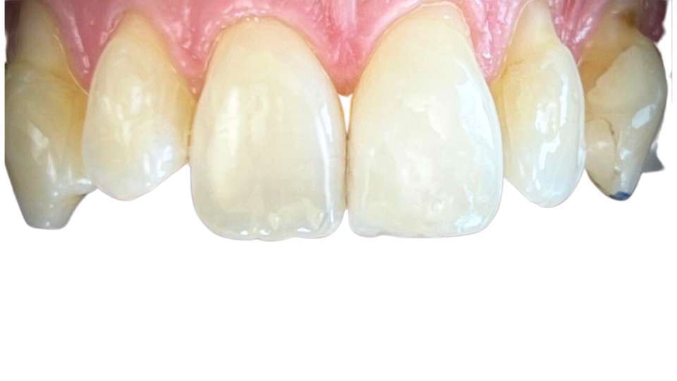 Abgebrochener Zahn mit Kompositaufbau