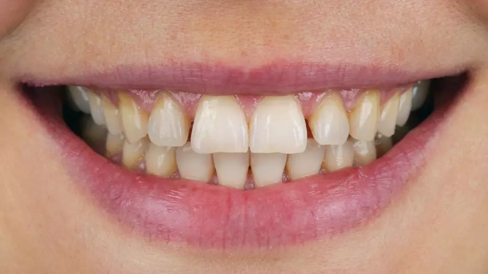 Vorher Veneers Schöne Zähne Zahnarzt Neu-Anspach